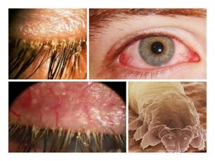 Symptome des Vorhandenseins von Parasiten unter der menschlichen Haut